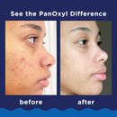 PanOxyl Acne Foaming Wash Benzoyl Peroxide 10% Maximum Strength antibacterial, 3 Oz, Pack of 2