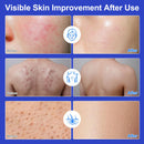 Folliculitis Treatment Cream, Fast Acting & Soothing for Folliculitis Scalp, Clogged Pores, Bumps, Excess Oil, for Face & Body|100g