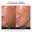 Paulas Choice-SKIN PERFECTING 2% BHA Liquid Salicylic Acid Exfoliant-Facial Exfoliant for Blackheads, Enlarged Pores, Wrinkles & Fine Lines, 4 oz Bottle (Pack of 2)