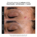Paulas Choice--SKIN PERFECTING 2% BHA Liquid Salicylic Acid Exfoliant--Facial Exfoliant for Blackheads, Enlarged Pores, Wrinkles & Fine Lines, 4 oz Bottle