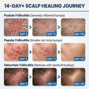 Folliculitis Treatment Cream - 5% Benzoyl Peroxide & Tea Tree Oil for Scalp Bumps, Razor Burn & Body Breakouts - Fast Acting & Effective Itch Relief - 100g/3.53oz