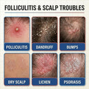 Folliculitis Treatment Cream - 5% Benzoyl Peroxide & Tea Tree Oil for Scalp Bumps, Razor Burn & Body Breakouts - Fast Acting & Effective Itch Relief - 100g/3.53oz