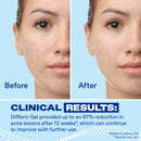 Differin Acne Retinoid Treatment Gel, 0.1% Adapalene, 45g Pump